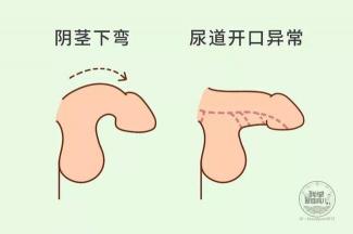 包皮过长的影响与术后护理：避免早泄与不射精的困扰