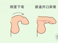 包皮过长的影响与术后护理：避免早泄与不射精的困扰