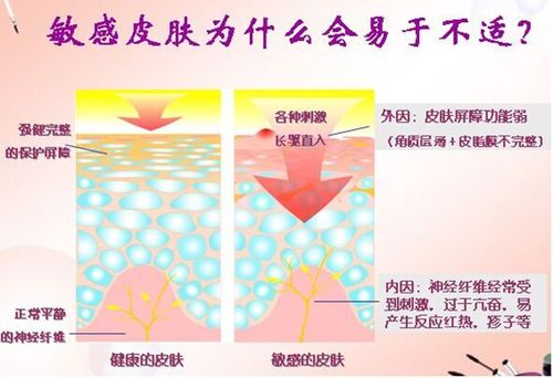 红血丝的形成与保养：了解原因，掌握方法