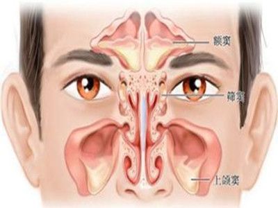 鼻咽炎症状：了解症状，预防与治疗