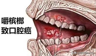 食用槟榔方法与恢复因嚼槟榔导致的大脸策略