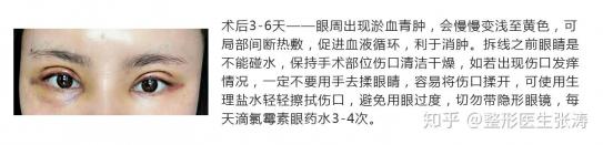 冬季做双眼皮手术：恢复期、注意事项与选择合适的手术